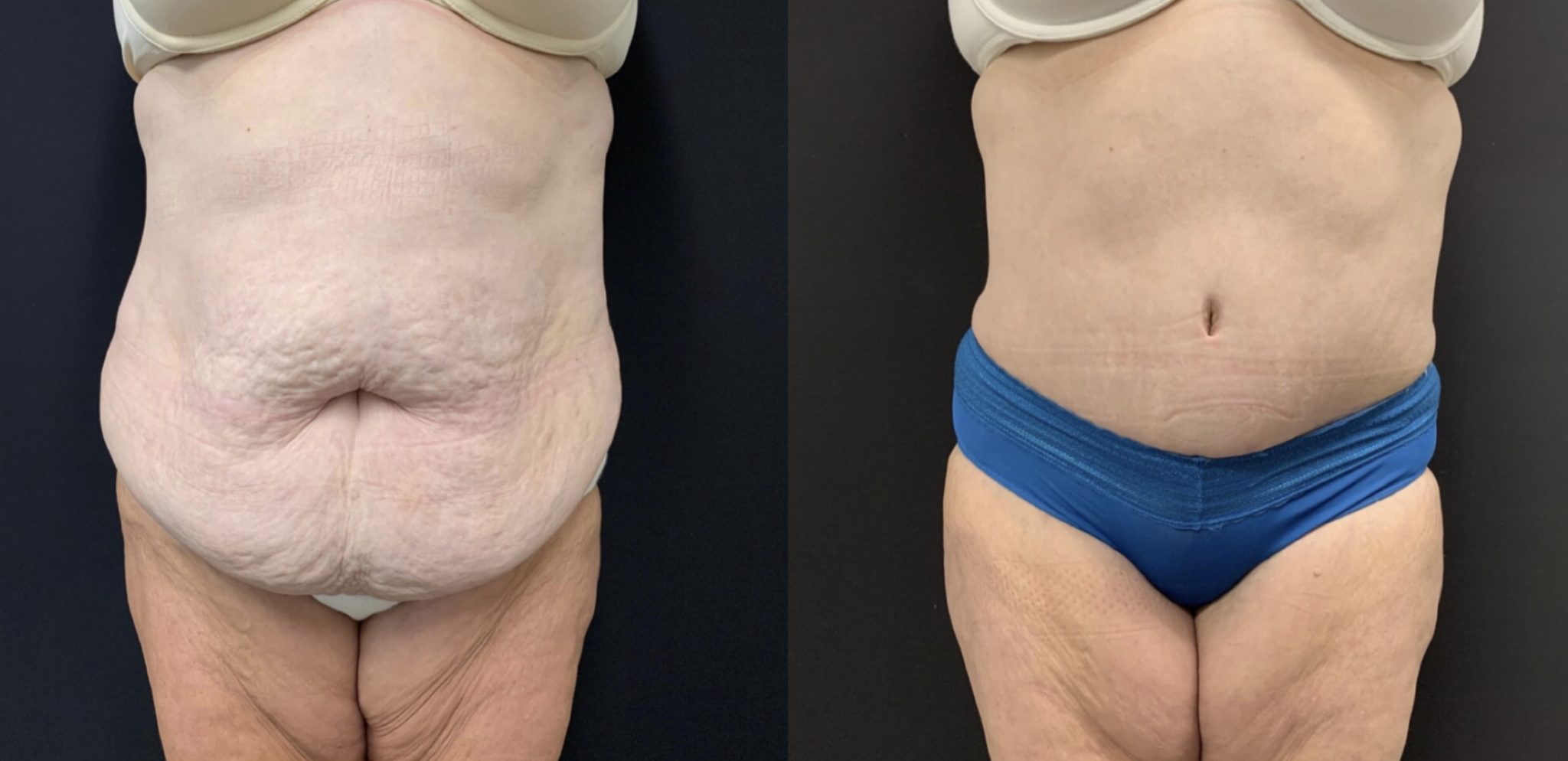ABDOMINOPLASTY Before & After Case Number 00051