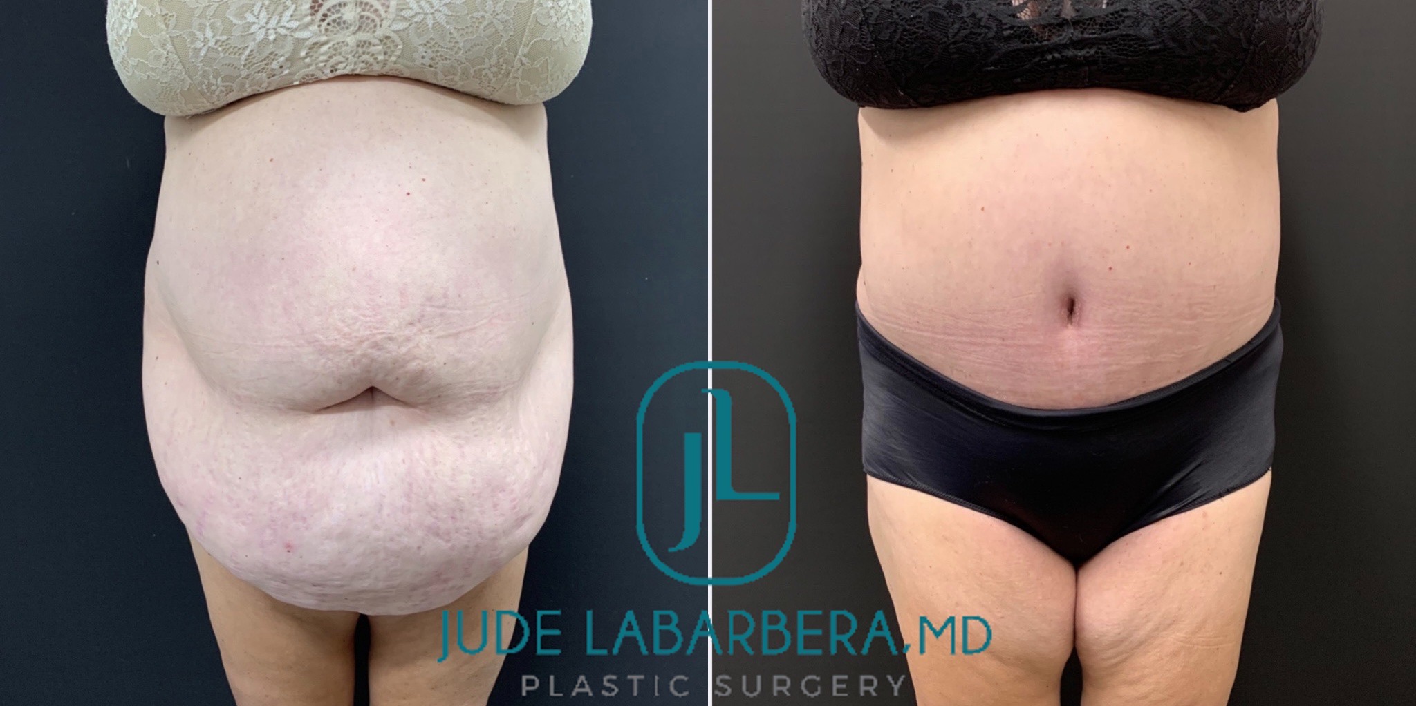 Abdominoplasty Before & After Case Number 00080
