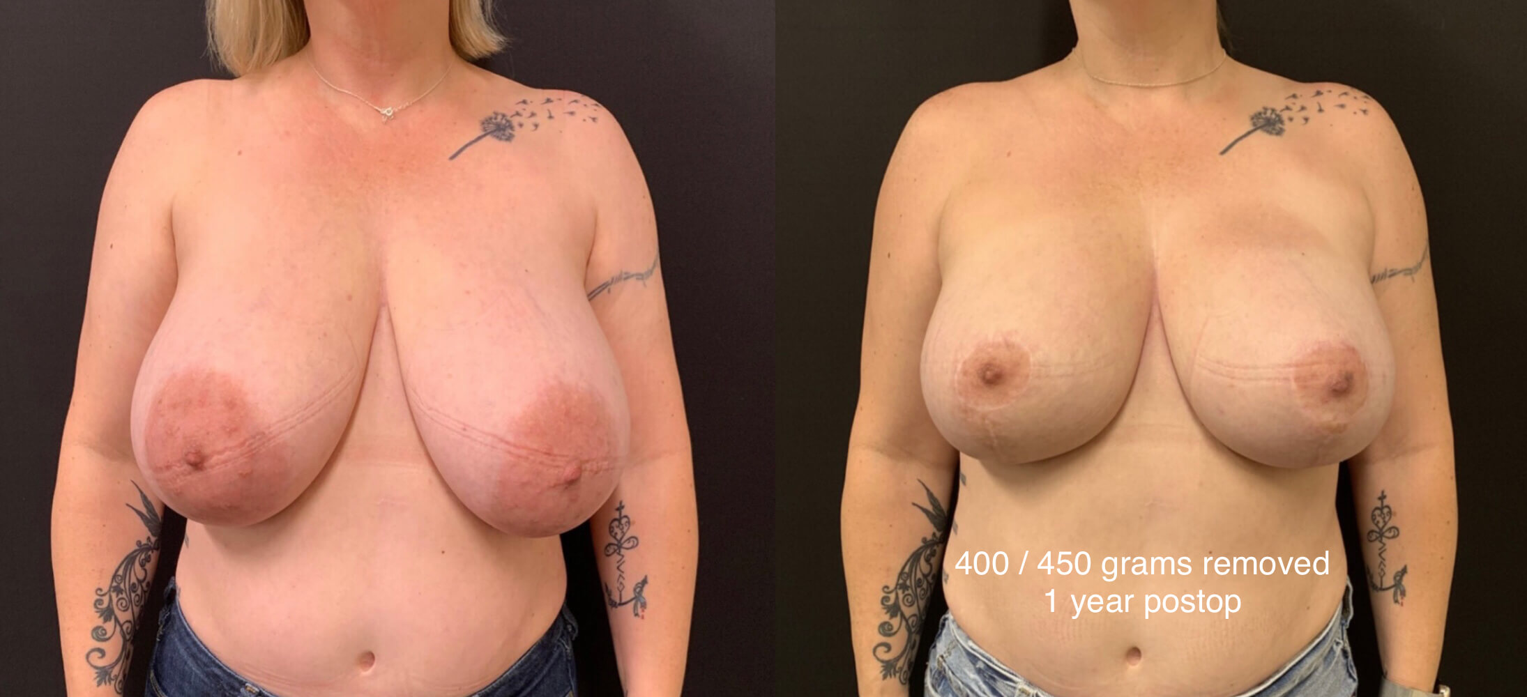 BEAUTIFUL BREAST REDUCTION Before & After Case Number 0001