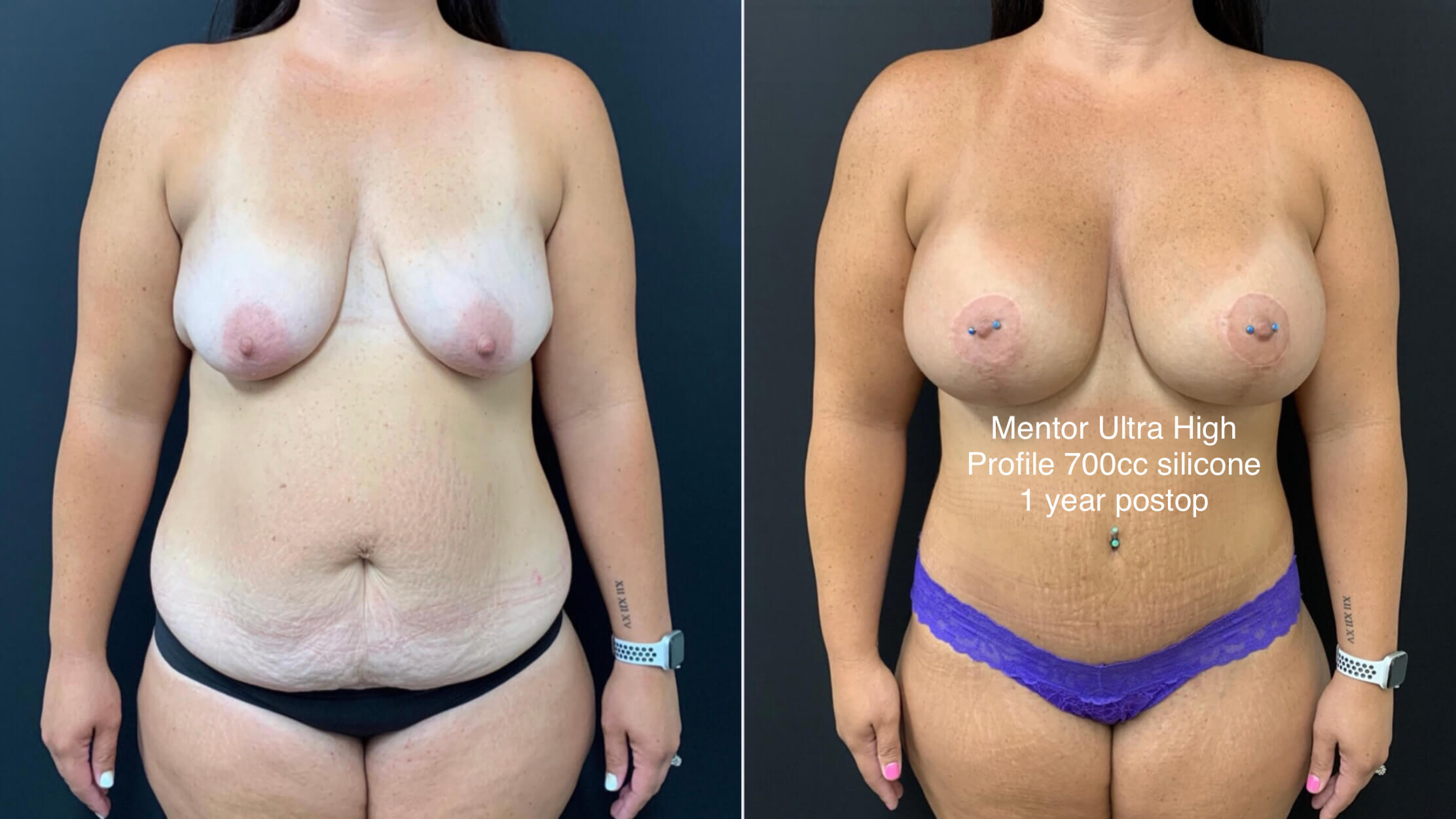 BEAUTIFUL ULTRA HIGH PROFILE BREAST AUGMENTATION WITH LIFT AND TUMMY TUCK Before & After Case Number 0001
