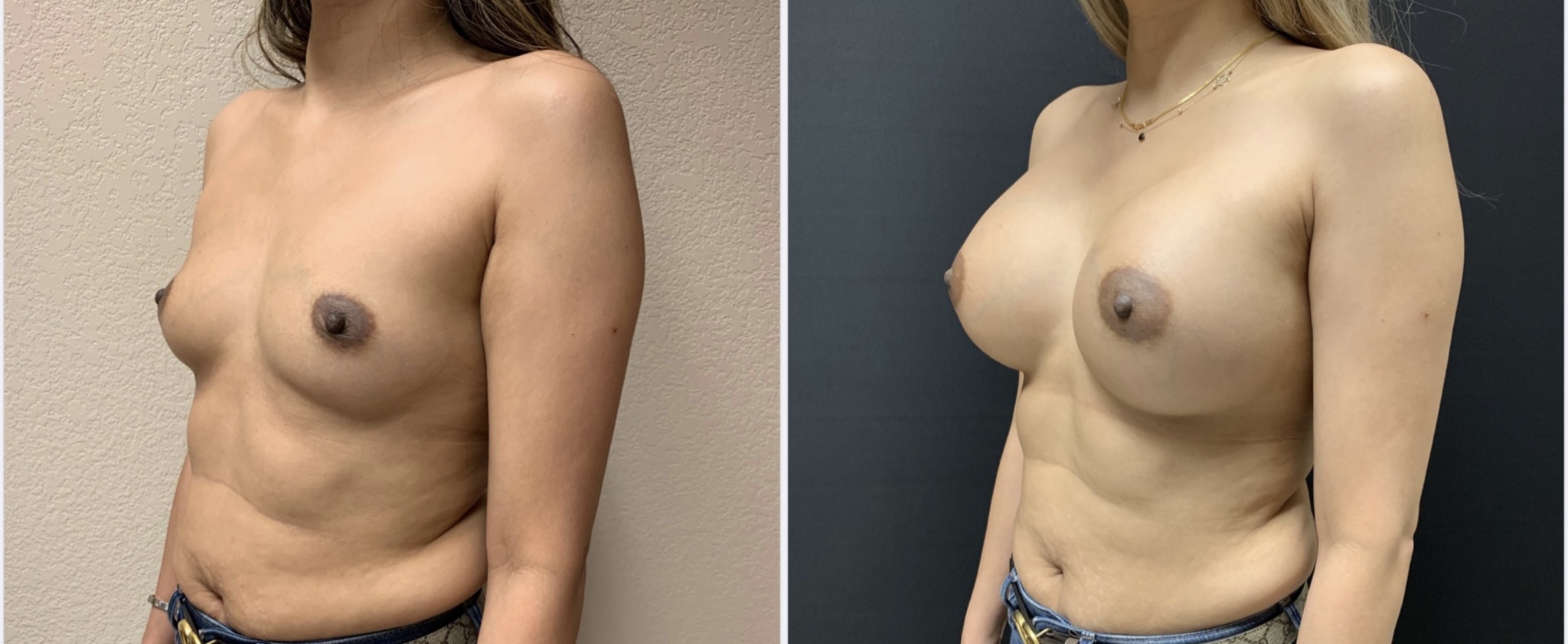 BREAST AUGMENTATION Before & After Case Number 00017