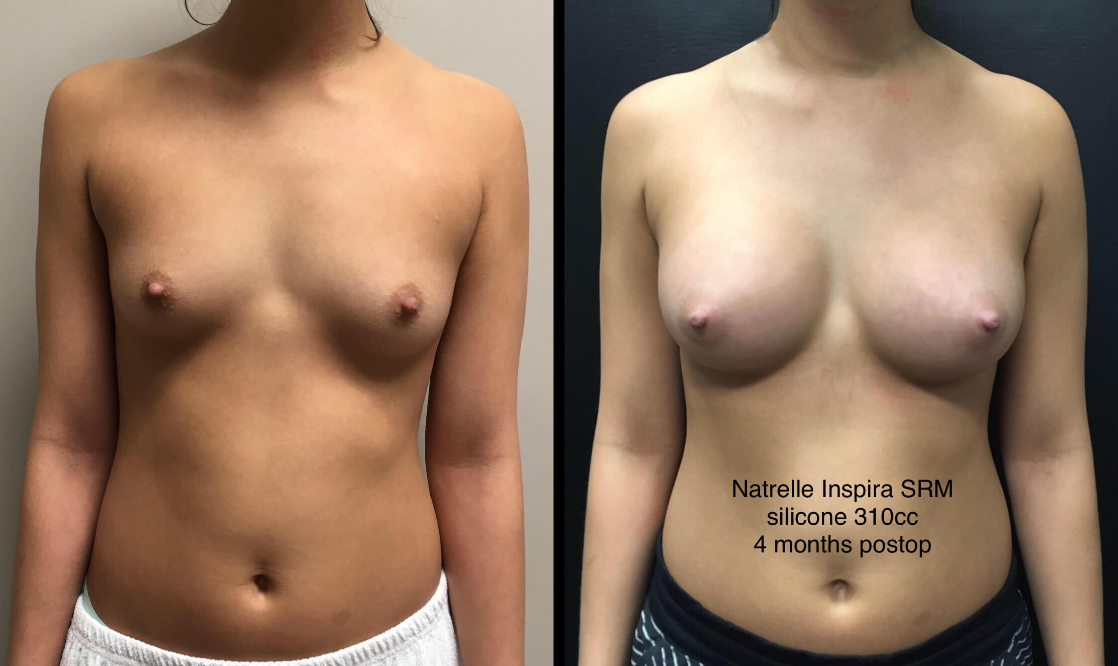 BREAST AUGMENTATION Before & After Case Number 00037