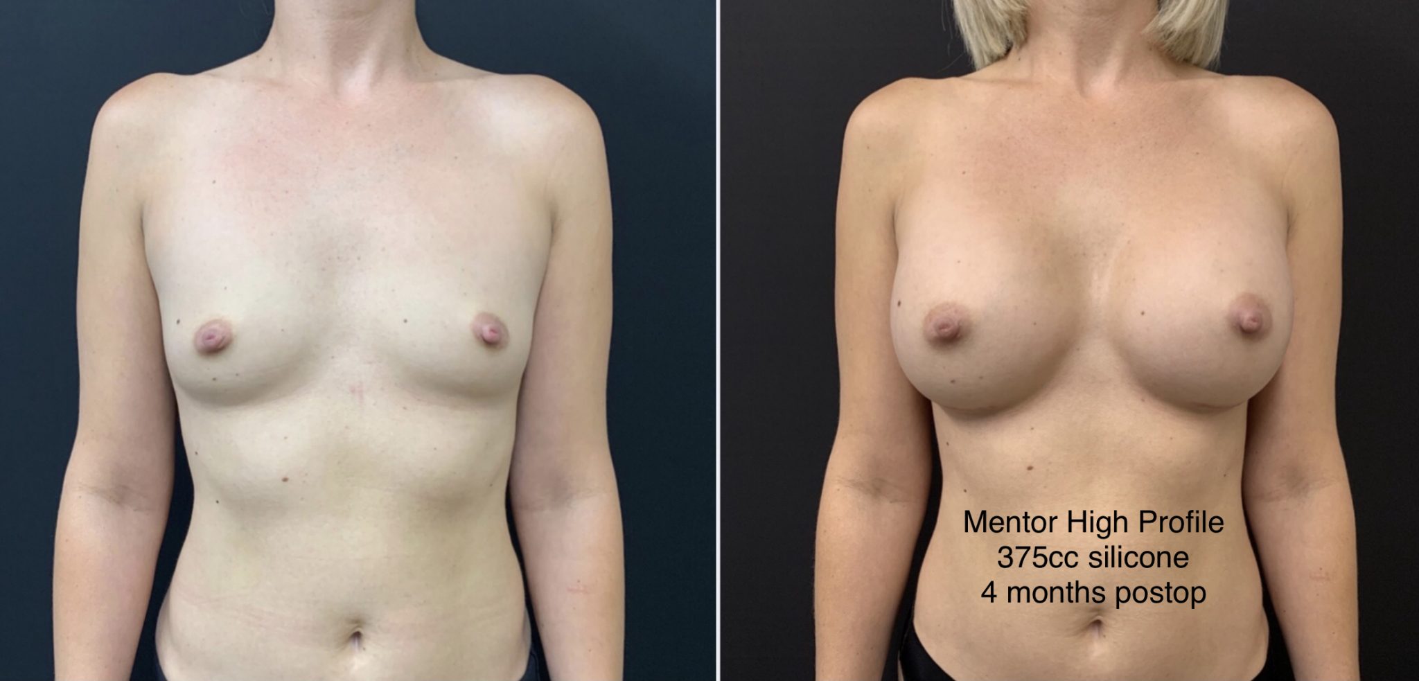 BREAST AUGMENTATION Before & After Case Number 00048