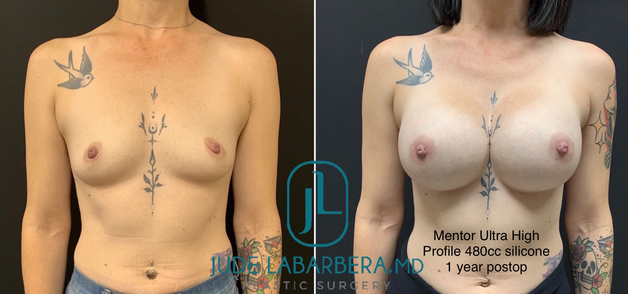 BREAST AUGMENTATION Before & After Case Number 00055