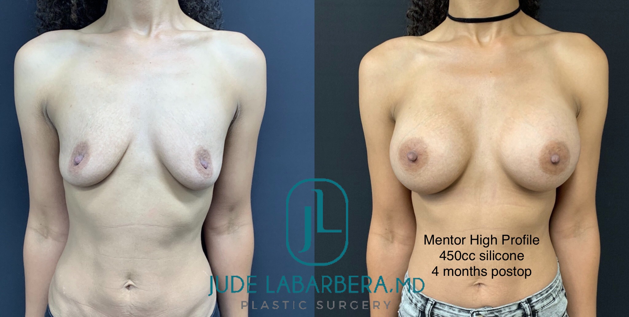 BREAST AUGMENTATION Before & After Case Number 00070