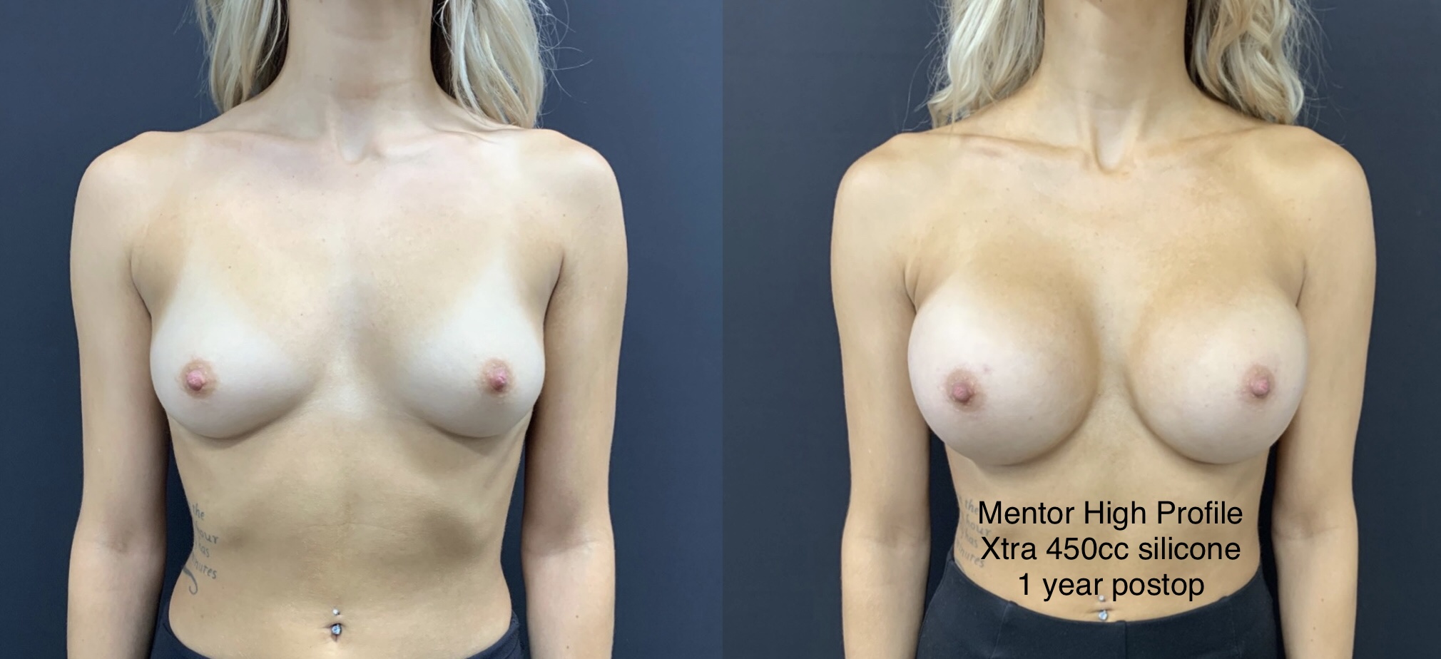 BREAST AUGMENTATION Before & After Case Number 00071