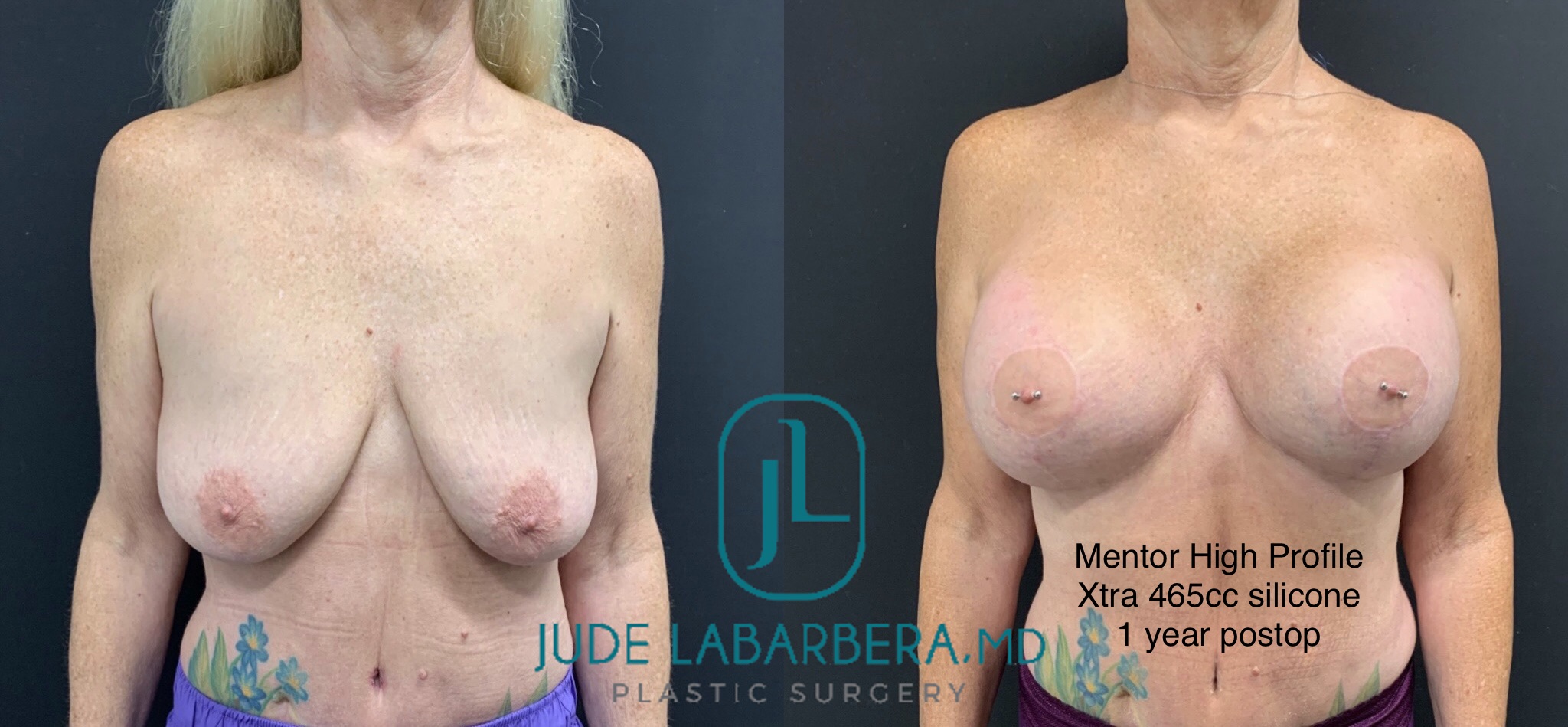 BREAST AUGMENTATION WITH LIFT Before & After Case Number 00012
