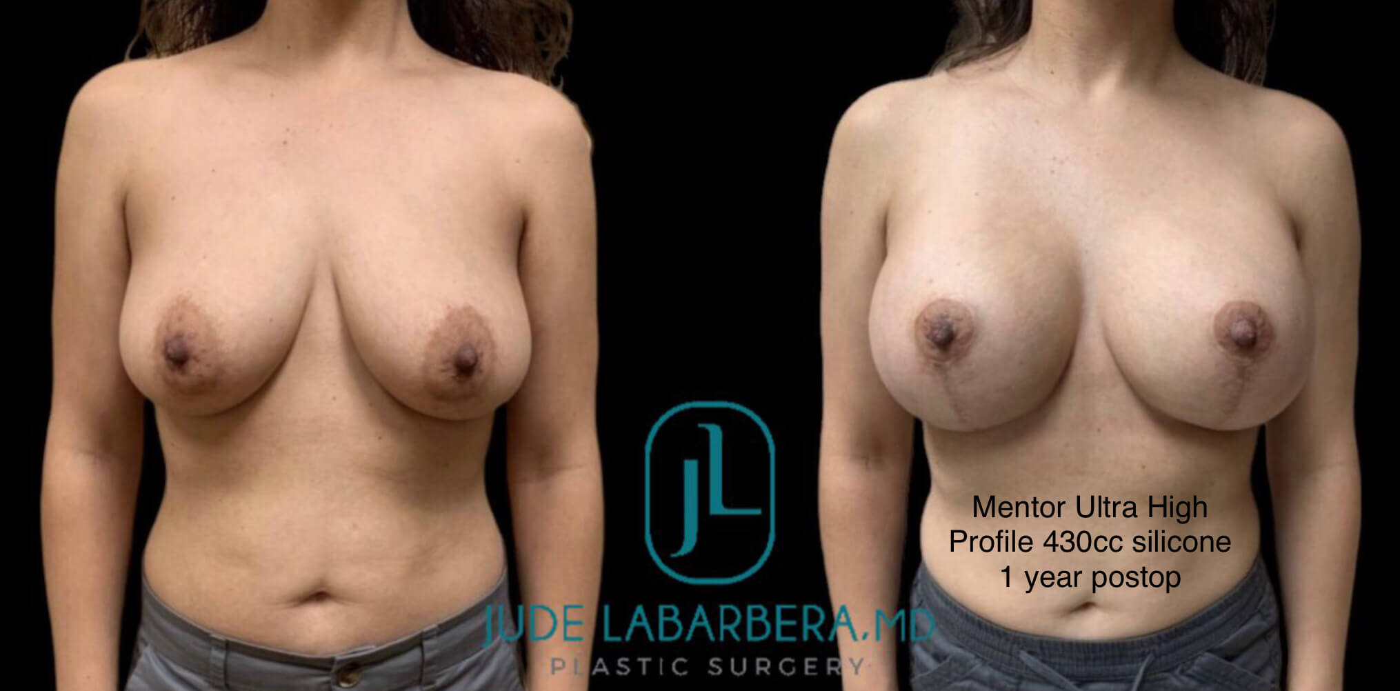 BREAST AUGMENTATION WITH LIFT Before & After Case Number 0009