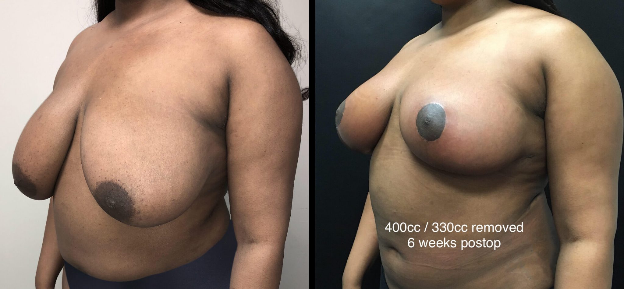BREAST REDUCTION Before & After Case Number 0002