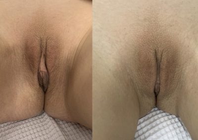 labiaplasty-before-after-3