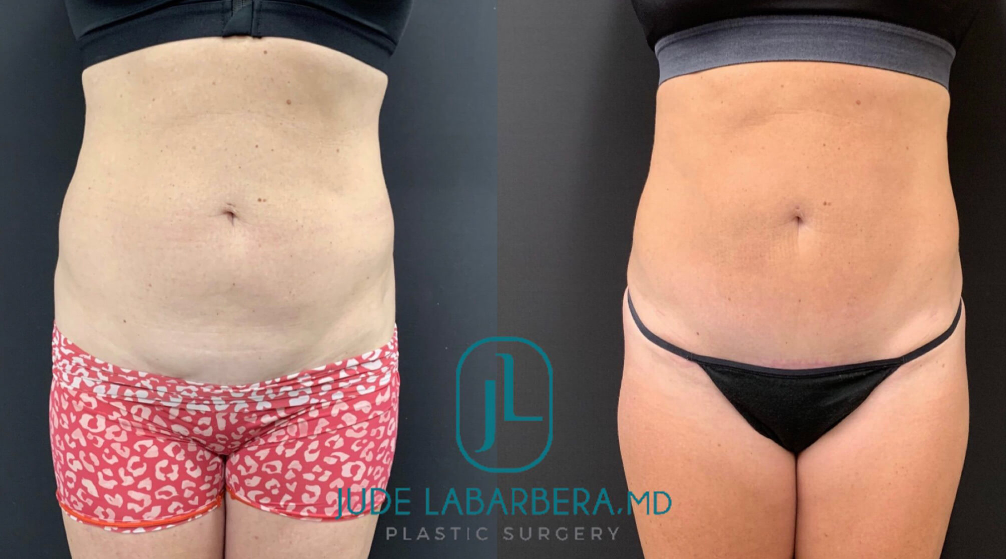 MINI TUMMY TUCK Before & After Case Number 00082