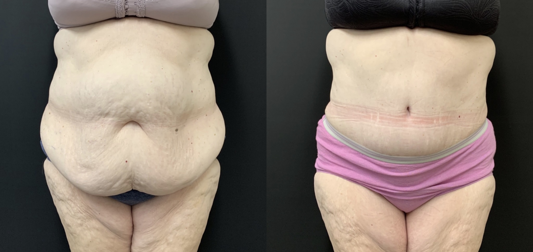 NATURAL Tummy Tuck Before & After Case Number 0005