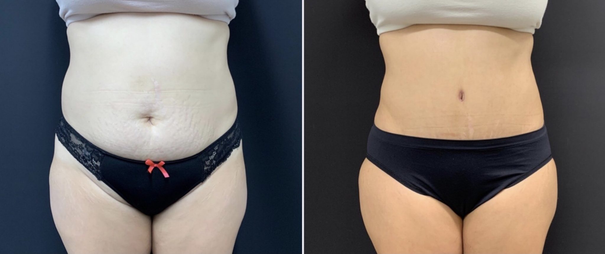 Tummy Tuck Before & After Case Number 00010