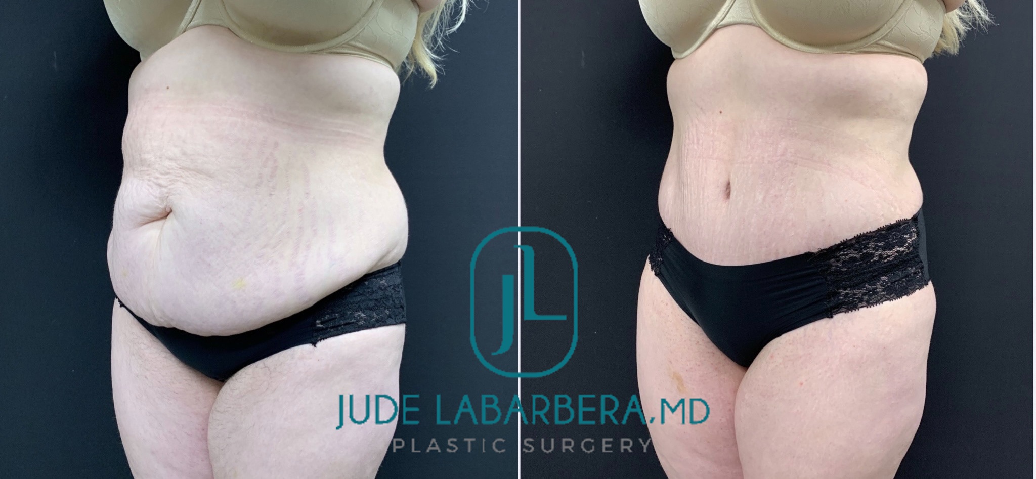 TUMMY TUCK Before & After Case Number 000106
