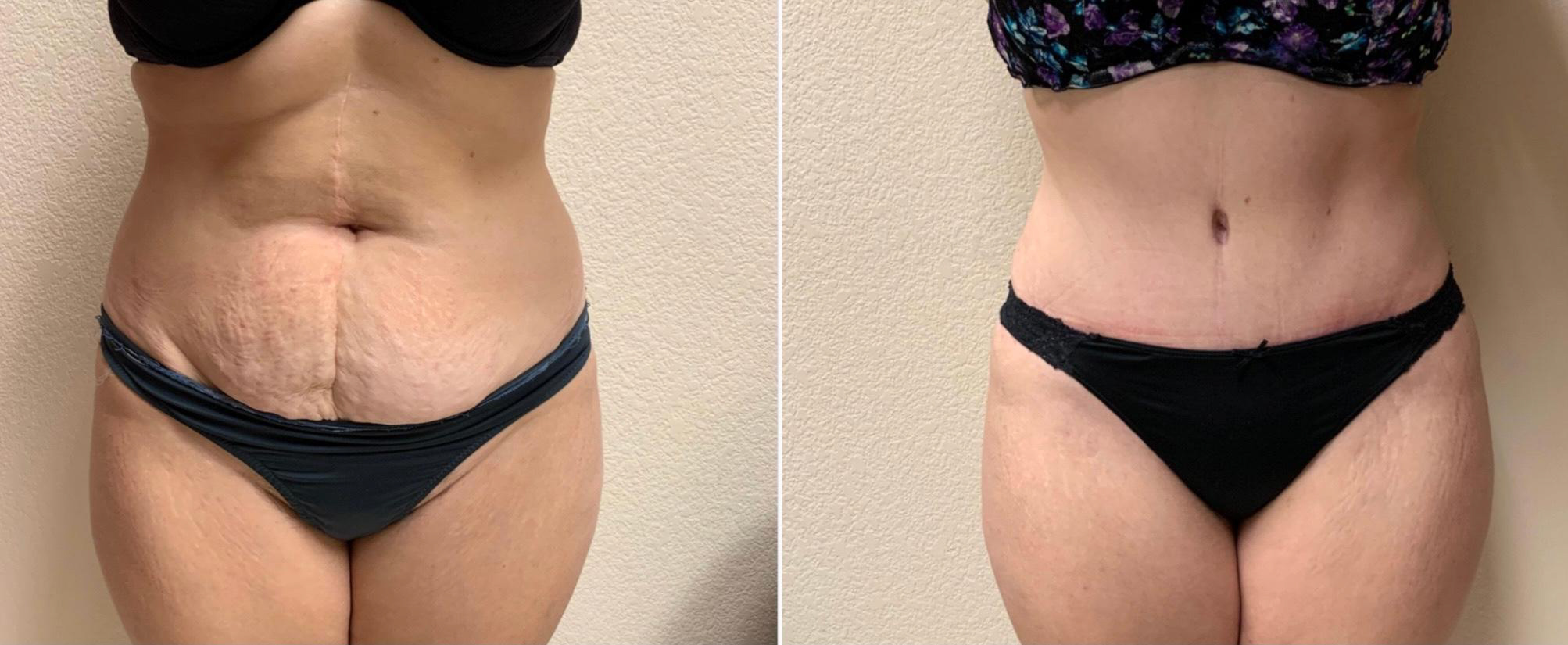 Tummy Tuck Before & After Case Number 00040