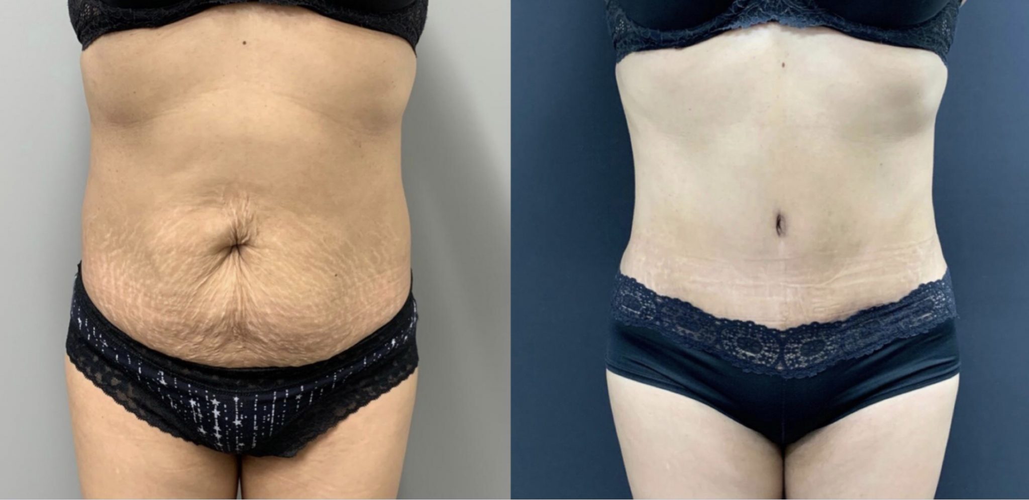 Tummy Tuck Before & After Case Number 00045