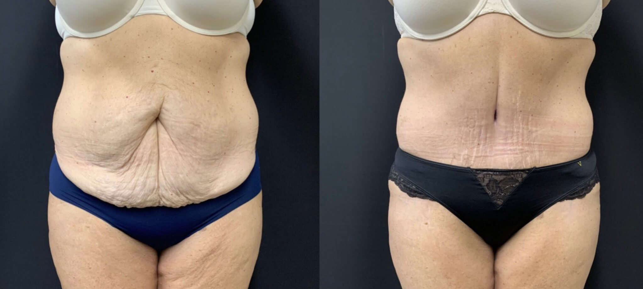TUMMY TUCK Before & After Case Number 00055