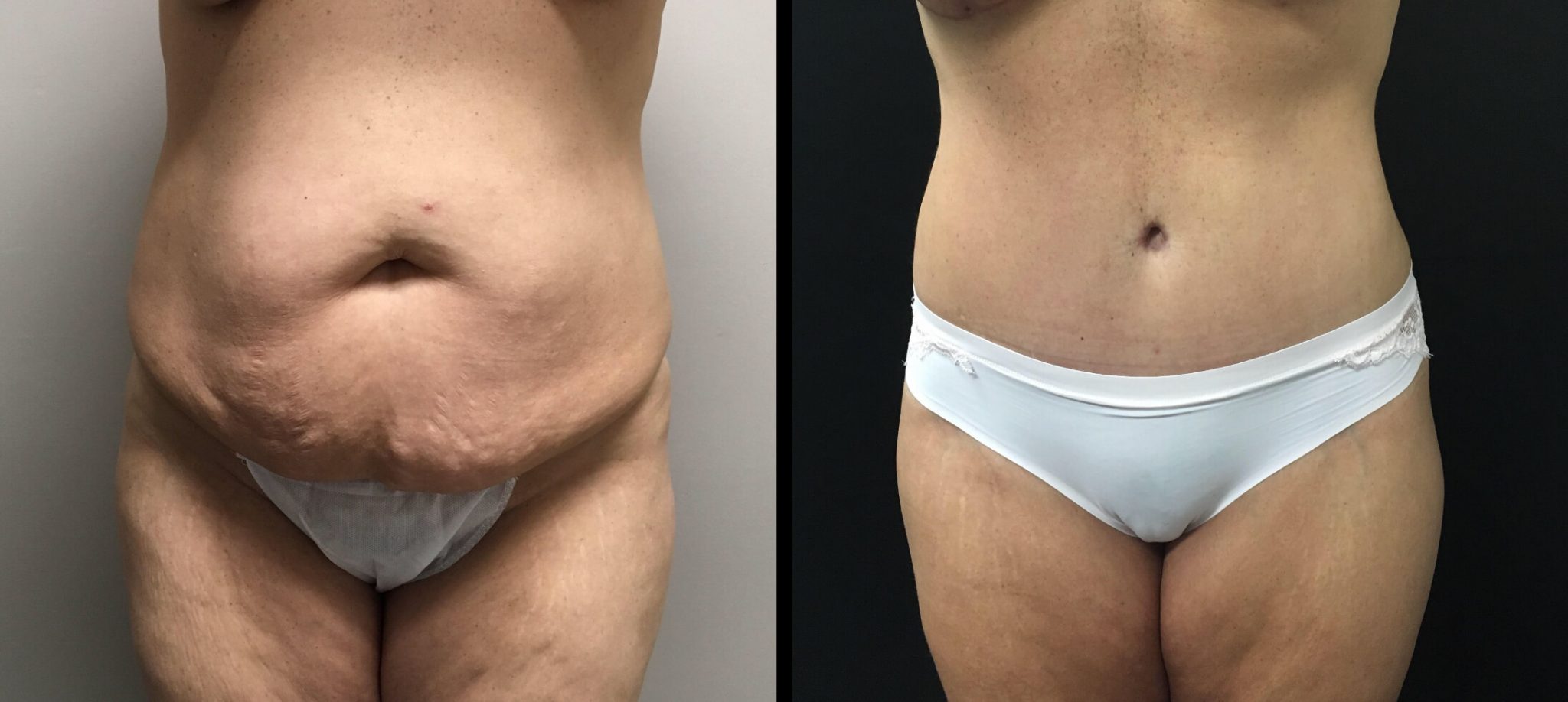 TUMMY TUCK Before & After Case Number 00056