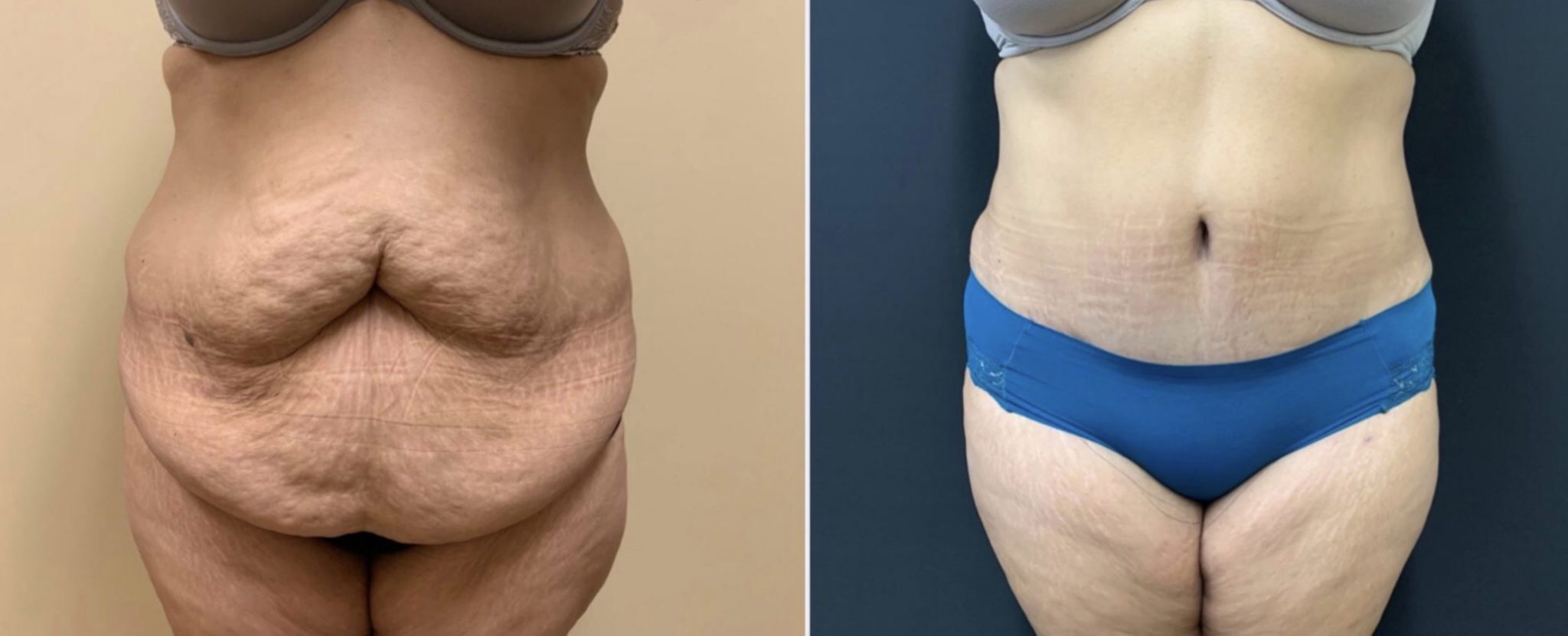 TUMMY TUCK Before & After Case Number 00058