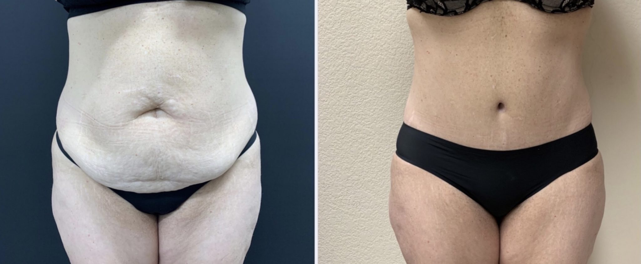 TUMMY TUCK Before & After Case Number 00059