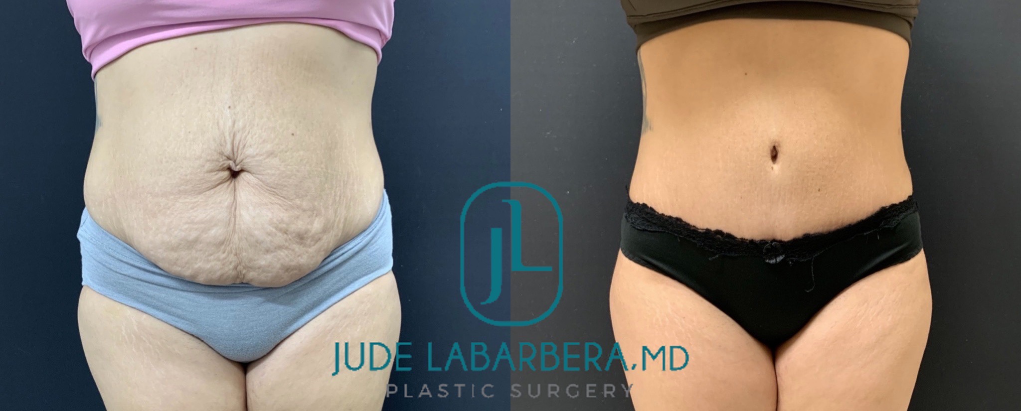 TUMMY TUCK Before & After Case Number 00072