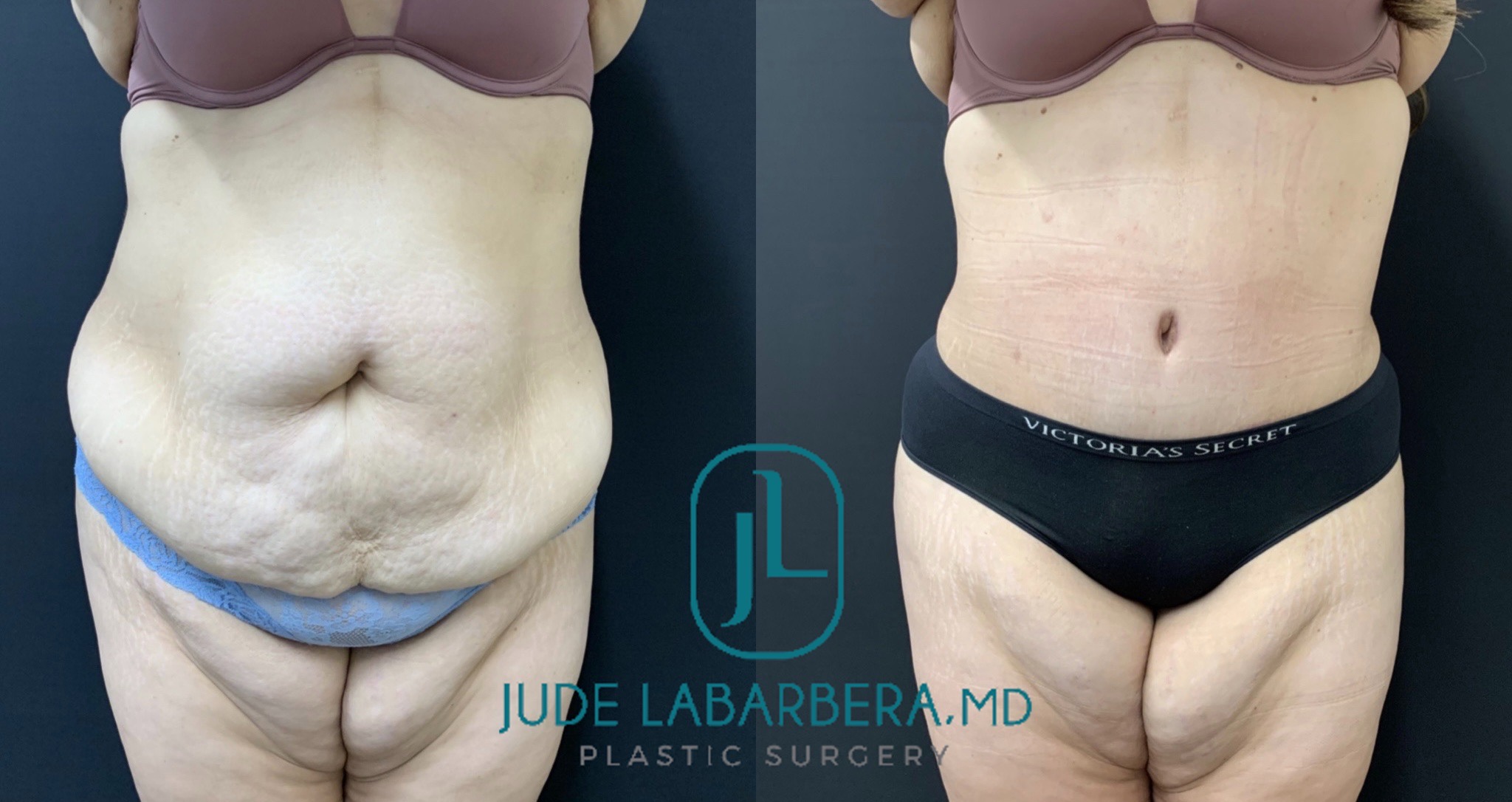 TUMMY TUCK Before & After Case Number 00074