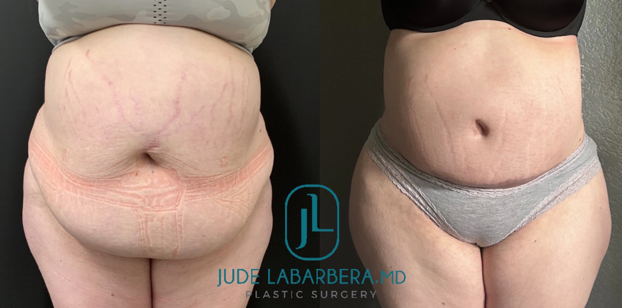 TUMMY TUCK Before & After Case Number 00075