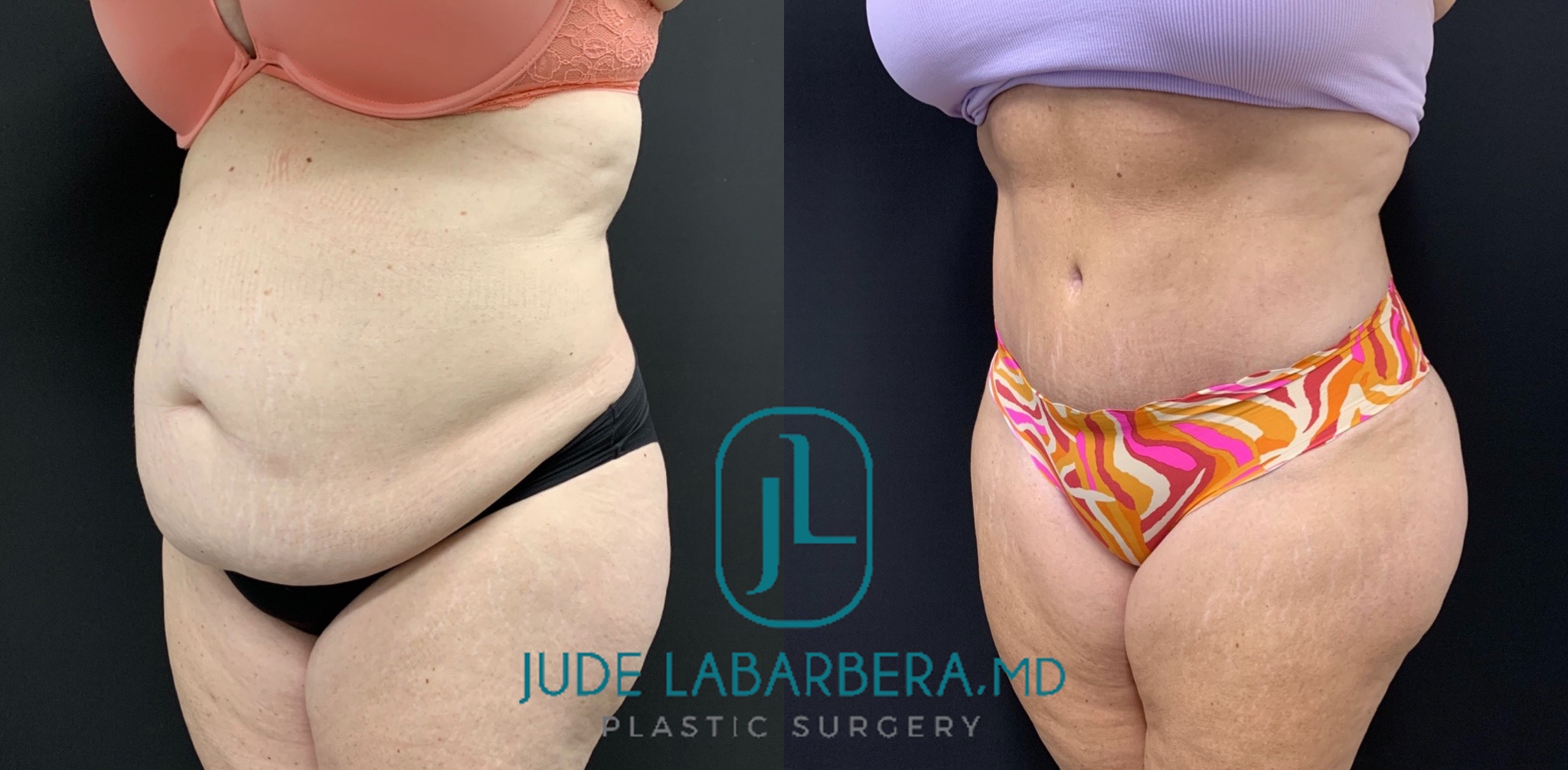 TUMMY TUCK Before & After Case Number 00084