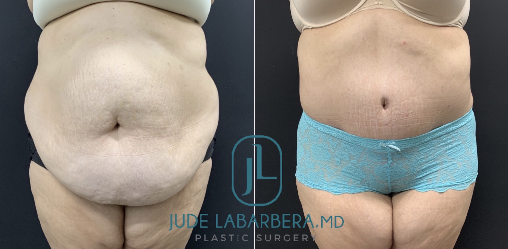 TUMMY TUCK Before & After Case Number 00094