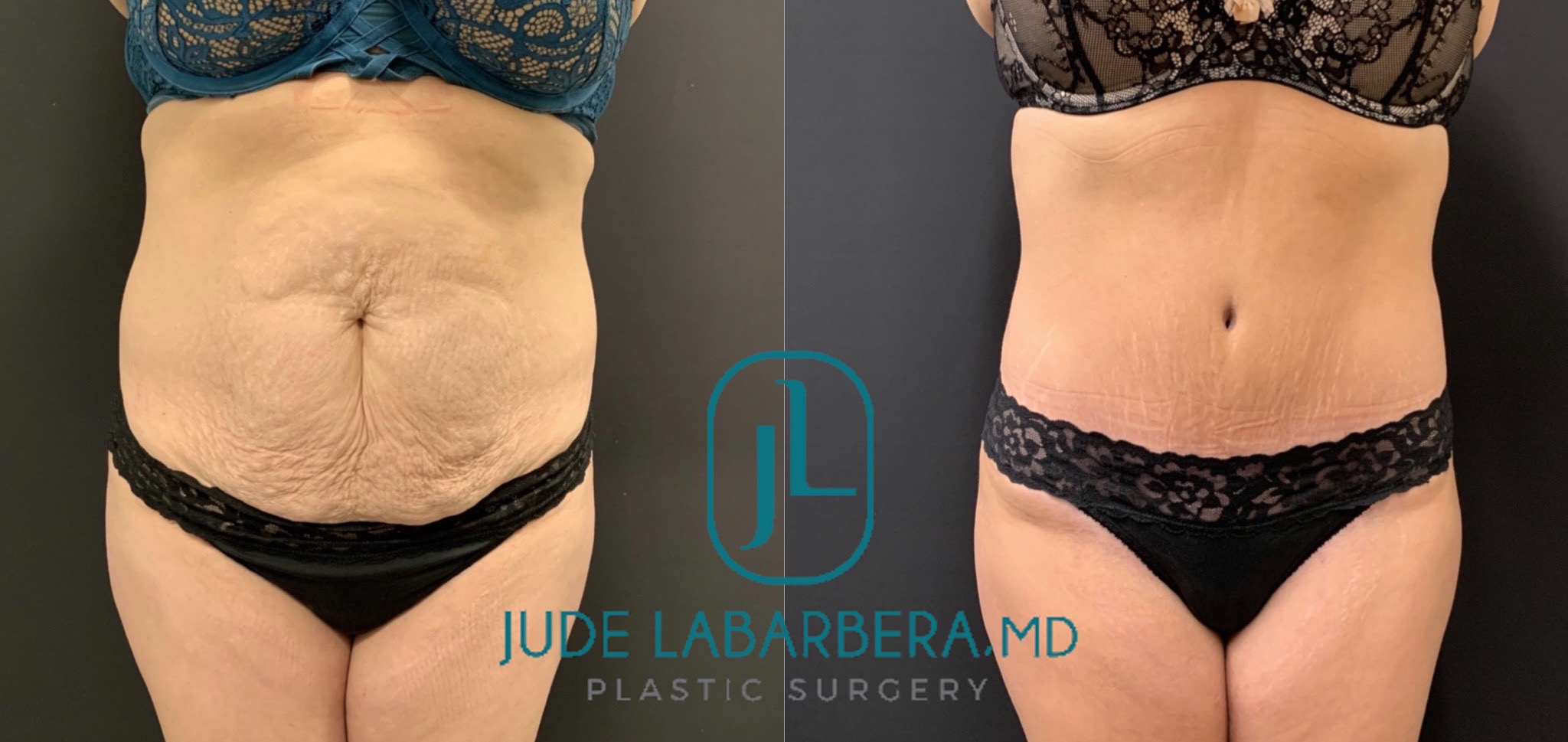 TUMMY TUCK Before & After Case Number 00096
