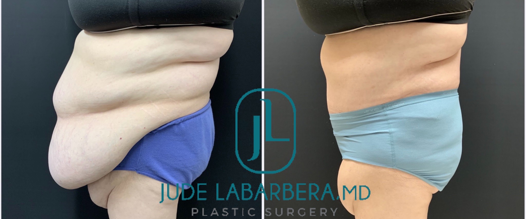 TUMMY TUCK ON PLUS SIZE PATIENT Before & After Case Number 000112